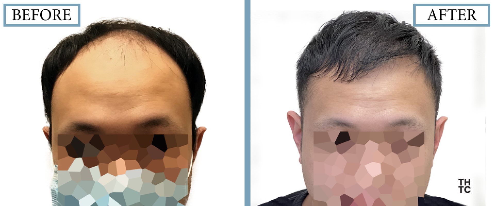 Hair Transplant Toronto